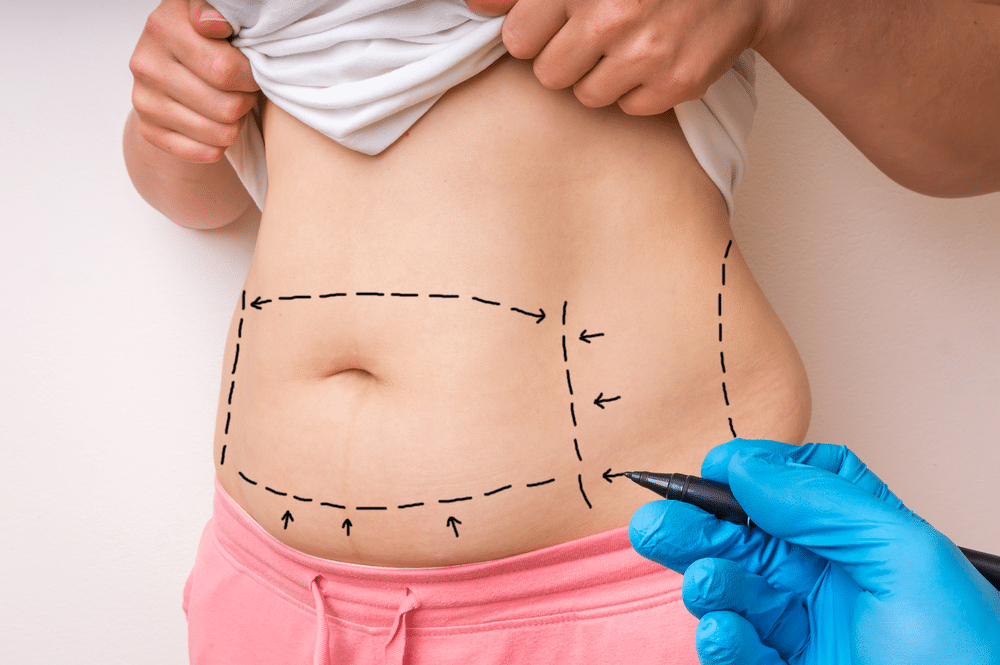 How Much Does Liposuction Cost