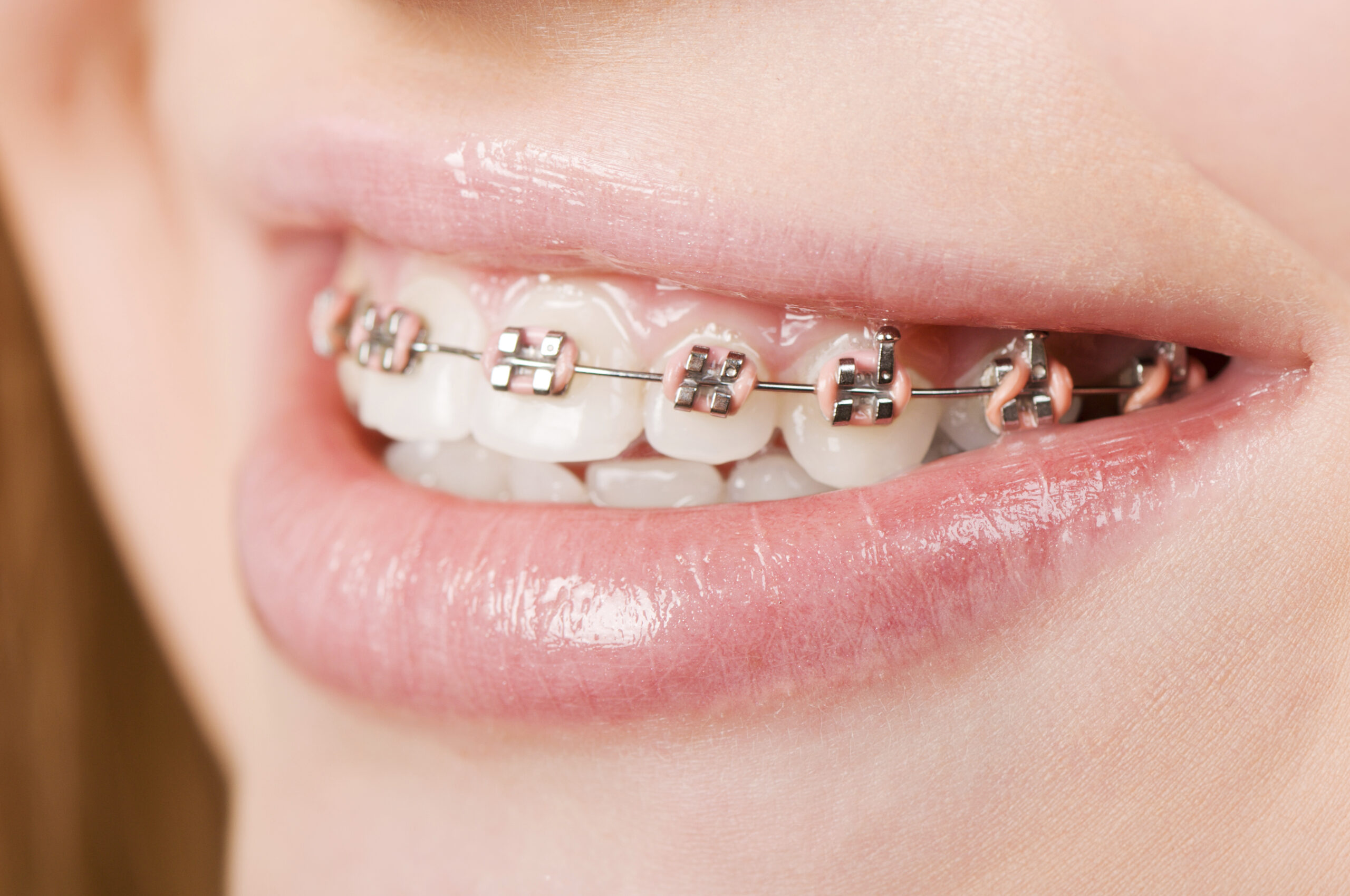 Why Are Braces So Expensive?